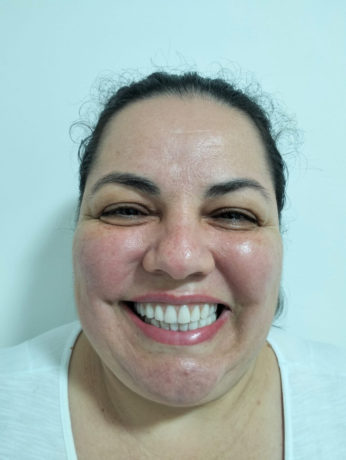 Paciente sorrindo após reabilitação