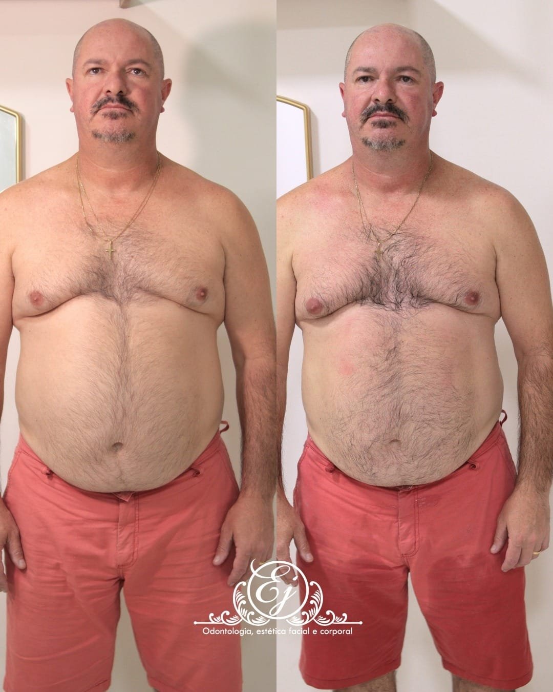 Resultado de tratamento corporal
